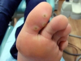 Verrugas plantares